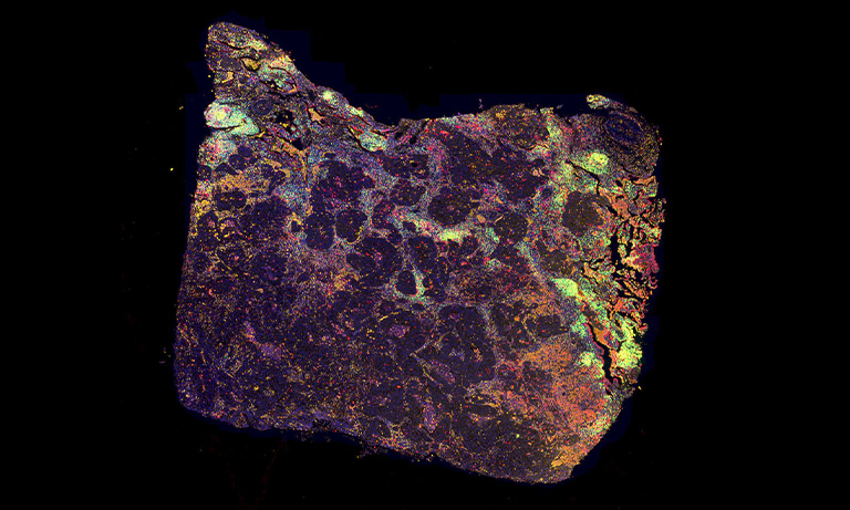 image of cancer tissues
